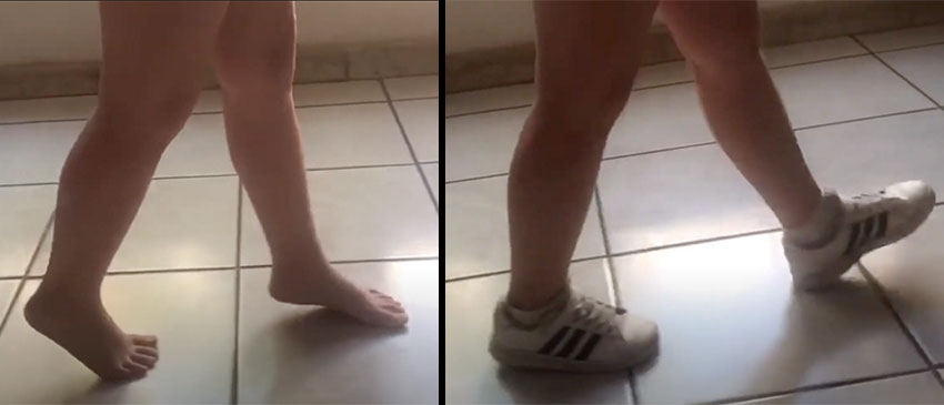 Child Toe Walking Improves After Wearing Anti Toe Walking Shoes