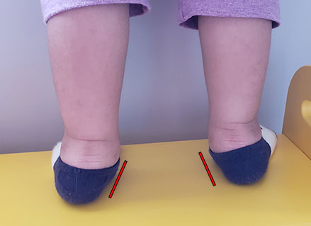 child-with-flat-feet-and-a-moderate-degree-of-pronation