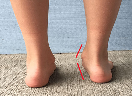 child-with-flat-feet-and-a-strong-degree-of-pronation