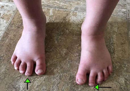 A child with his second toes longer than his big toes.
