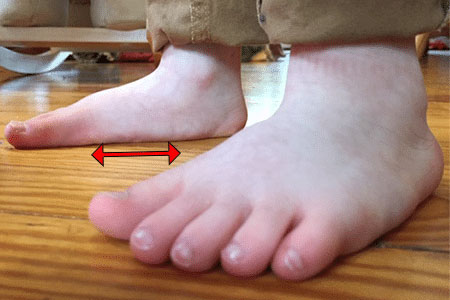 toddler-with-flat-feet