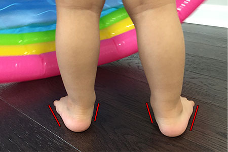 toddler-with-flat-feet