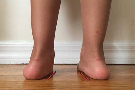 child-with-flat-feet