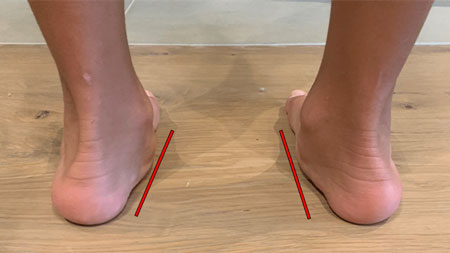 child-with-flat-feet-and-a-moderate-degree-of-pronation