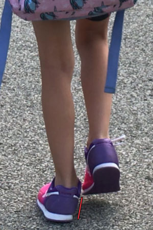 child-with-flat-feet-and-overpronation