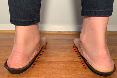 child-with-flat-feet-standing-on-unsupportive-insoles