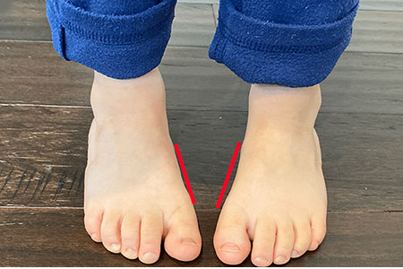 Corrective Shoes For Kids With Pigeon Toes To Improve Posture