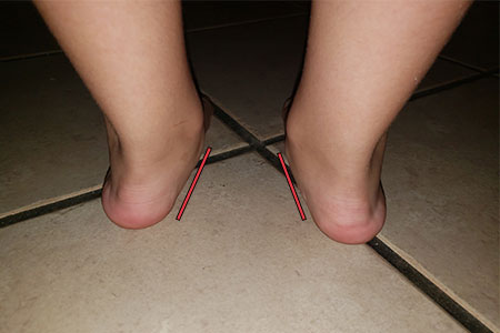 girl-with-flat-feet