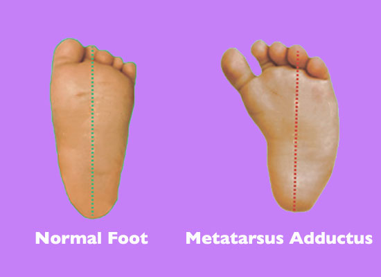 child-with-normal-foot-vs-child-with-metatarsus-adductus