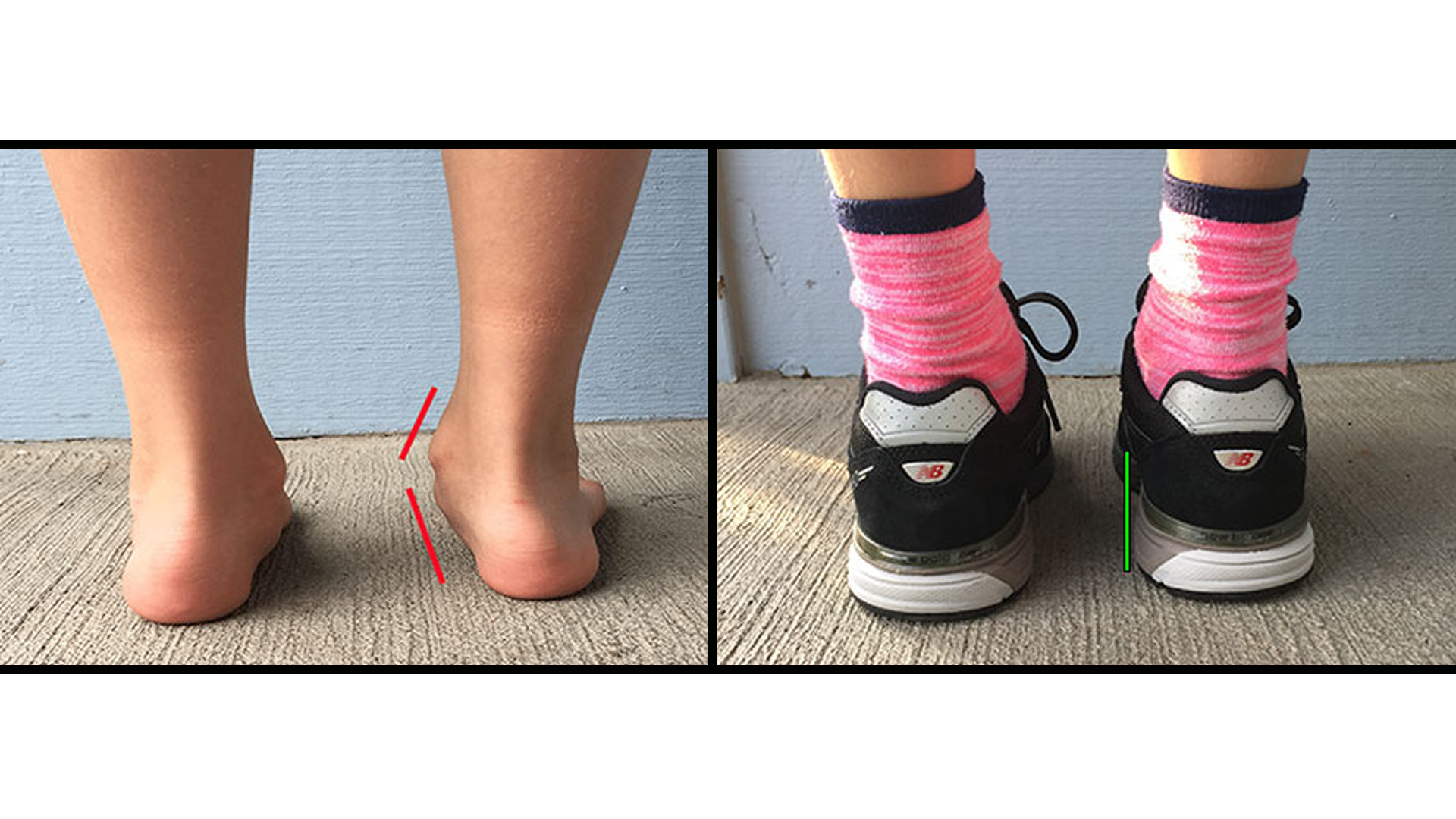 Before and after of a child with flat feet standing barefoot versus wearing the New-Balance 990 shoes with orthotics.