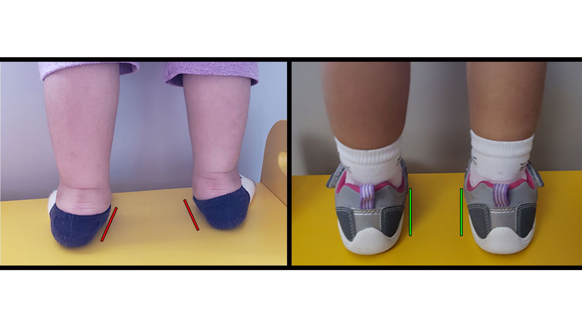 Before image of a toddler with flat feet standing barefoot versus after image of the same toddler wearing supportive shoes and littleSTEPS orthotics.