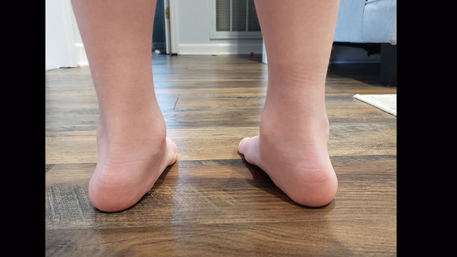 Child with a mild degree of pronation.